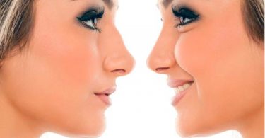 rinoplastia